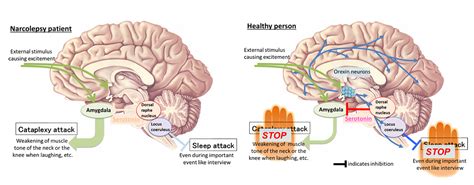 What Is Narcolepsy Health Life Media