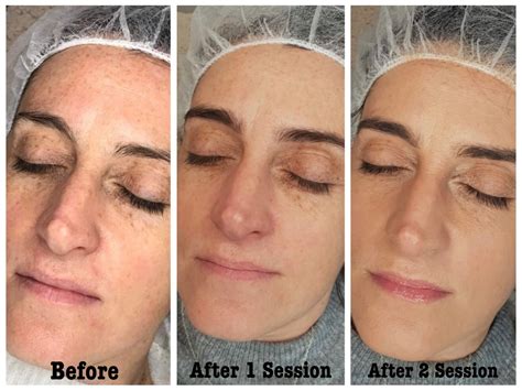 BB Glow Facial Singapore | BB GLOW Treatment | Facial Treatment