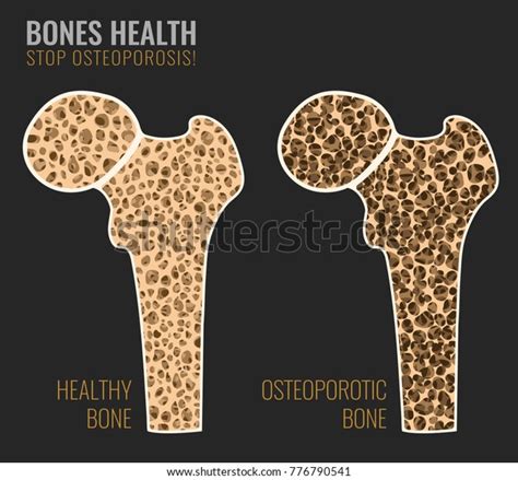 Osteoporosis System Disorder Template Portal Tutorials