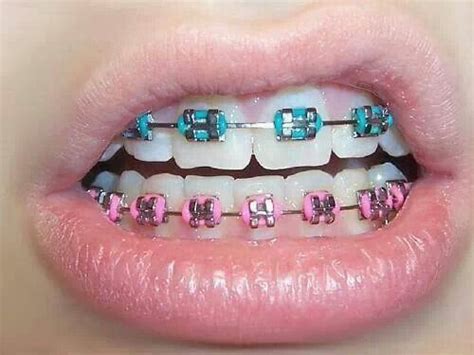 125 best images about braces on pinterest mouths getting braces and brushing