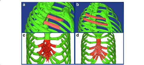 A C The Sternum And Rib Defects In The 3d Reconstruction Model For