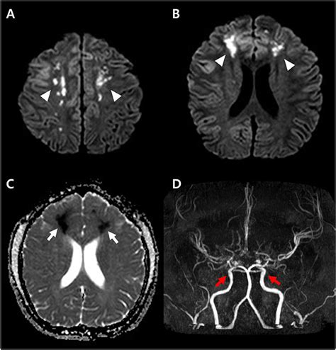 Frontiers Diffuse Cerebral Vasospasm After Aneurysmal Subarachnoid