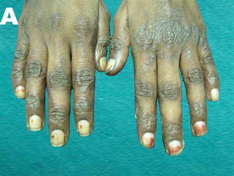 Acrodermatitis Enteropathica Like Skin Eruption In A Case Of Short