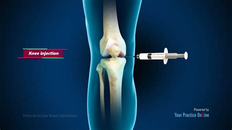 Intra Articular Knee Injections Video Medical Video Library