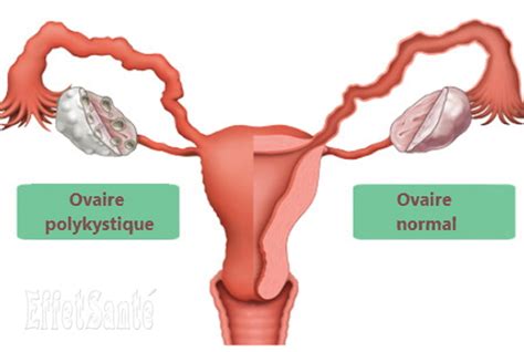 La Cause Du Syndrome Des Ovaires Polykystiques A T D Couverte