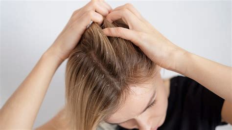 9 Home Remedies For Managing Scalp Psoriasis Effectively Onlymyhealth