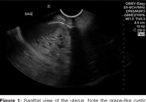 Figure 1 From Ultrasound Diagnosis Of A Molar Pregnancy Semantic Scholar