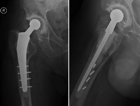 Cemented Total Hip Arthroplasty With Retention Of Some Existing