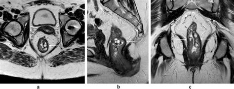 Colitis Cystica Profunda A Variant Of Solitary Rectal Ulcer Syndrome