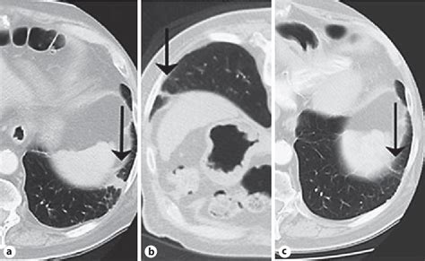 Figure 1 From The Interventional Radiologists Perspective On Lung
