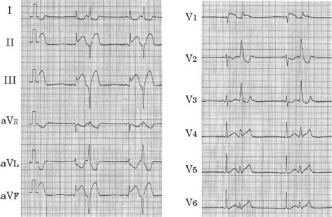 Ecg Showed Remarkable St Elevation In Leads Ii Iii Av F And V 1 And