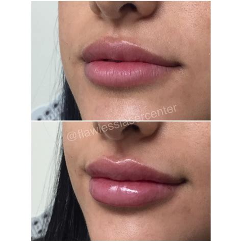 What A Flawless Before And After To Achieve This Clients Perfect Pout