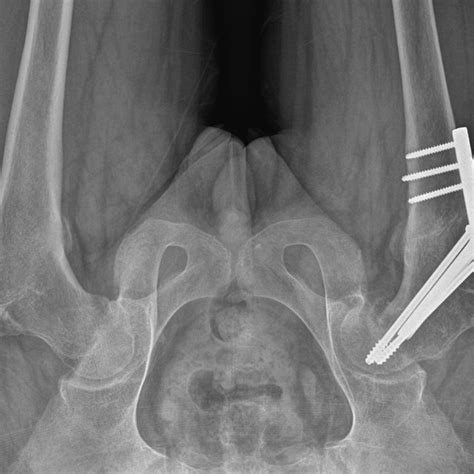 Postoperative Plain Radiograph Of The Hip Shows Valgus Osteotomy