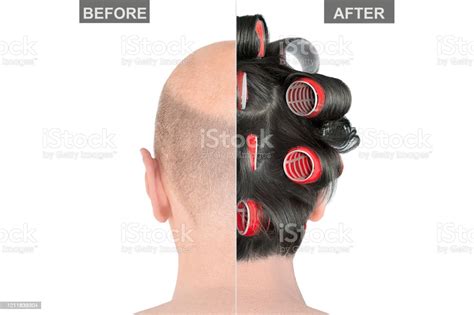 Bald Man Head Before And After Hair Transplantation Isolated On White Background Creative