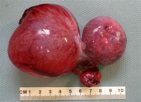Qiaos Pathology Ovarian Torsion（乔氏病理学：卵巢扭转） Gross Photo Flickr