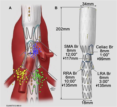 Endovascular Repair Of Thoracoabdominal Aortic Aneurysm Using The Off