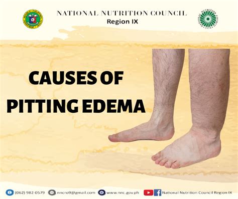 Know The Causes Of Pitting Edema