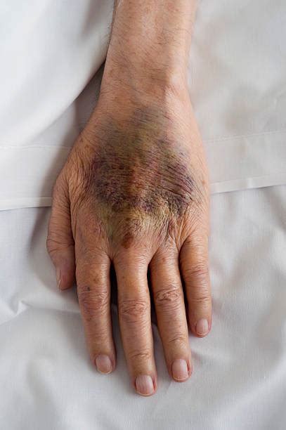 Bruise Purple Hemorrhage Contusion Stock Photos Pictures And Royalty