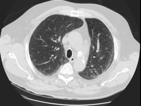 141lu Fibrotic Nsip Possible Lungs