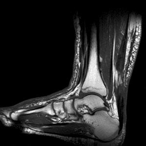 Il tendine di achille o tendine calcaneale è una terminazione fibrosa che collega il muscolo del polpaccio a all'osso posteriore del piede lo specialista del piede a roma che più si occupa di curare e prevenire queste patologie, compresa la rottura del tendine d'achille è il dr. Rottura del tendine di Achille : sintomi, cause, cure e ...