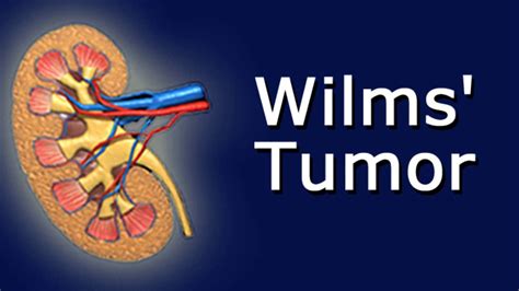 Wilms Tumor Youtube
