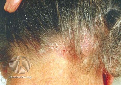 Dandruff Vs Seborrheic Dermatitis