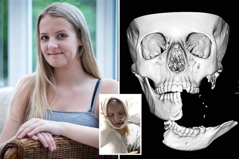 Teen Had To Catch Her Own Jaw After It Was Torn Off In Horse Riding