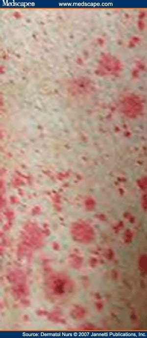 Managing Cutaneous Vasculitis In A Patient With Lupus Erythematosus