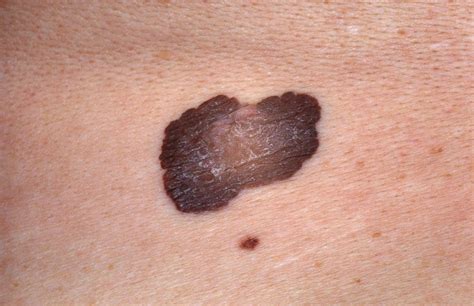 Cancerous Melanomas Can Seem Like They Re Only Skin Deep Good Morning America