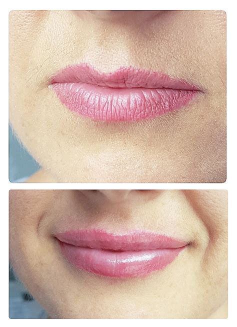 Hyaluronic Acid Lip Fillers Permanent Beauty Fabrique Marta Szewczyk