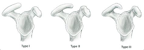 Acromion Types Radiology