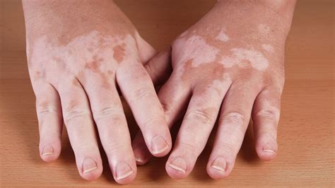 Hammerling Got White Spots On Your Skin It Could Be Vitiligo