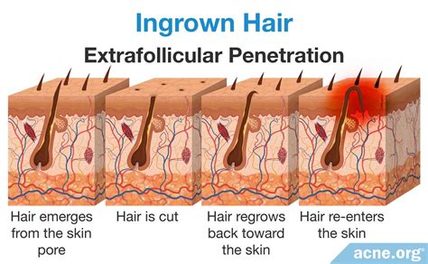 What Are Ingrown Hairs