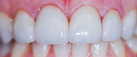 Hygiene Gum Treatment Southampton Periodontics Burgess Road Dental