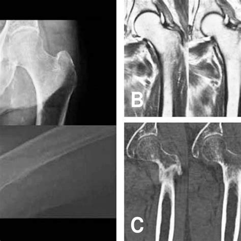 A Case Of Isolated Greater Trochanteric Fracture Showing Different