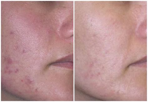 Bbl Laser Before And After Altaire Clinic