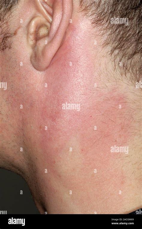 Swollen Lymph Nodes In The Neck Cervical Lymphadenopathy In A 34 Year