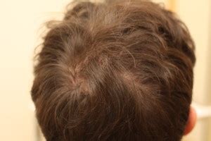Does thin hair mean i'm going to go bald in the future? I'm 24 Year And My Father Is Balding - Will I Also Bald ...