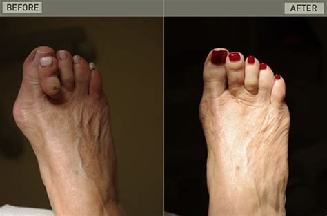 Cosmetic Foot Surgery Before And After Corrective Foot Surgery New York