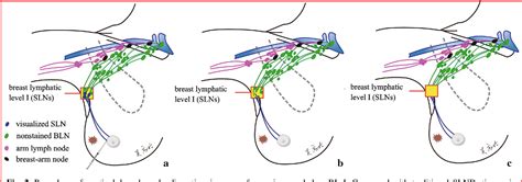 Surgical Management Of The Axilla In Breast Cancer Patients With
