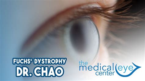 Dr Chao Explains What Fuchs Dystrophy Is Treatment Options YouTube