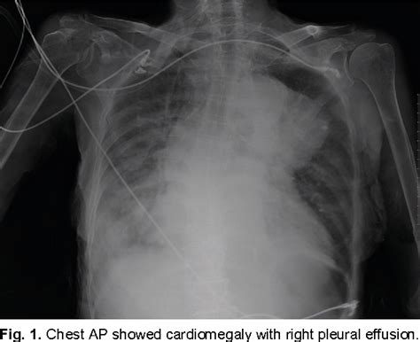 Figure 1 From A Case Of Aortopulmonary Fistula Caused By A Huge