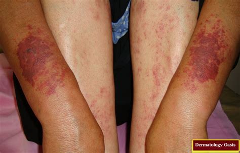 Purpuric Drug Eruption Dermatology Oasis