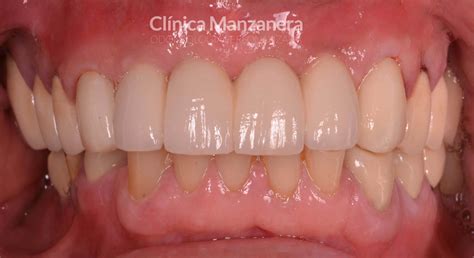 Caso clínico extracción y reposición puente dental sobre implantes
