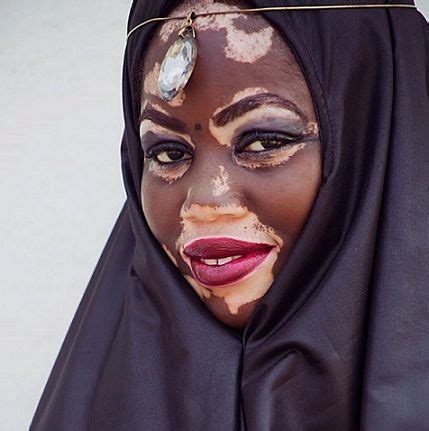 Maybe you would like to learn more about one of these? 10 Beautiful Images Of Women Shining With #VitiligoPride ...