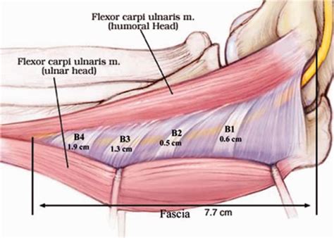 Challenging The Dogma Anterior Transposition Of The Ulnar Nerve Is