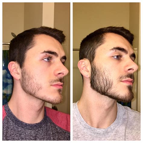 Minoxidil Before And After Beard Result Can Rogaine Minoxidil Make
