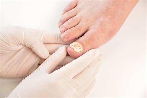 Nail Fungus Everything You Need To Know Apollo Hospital Blog