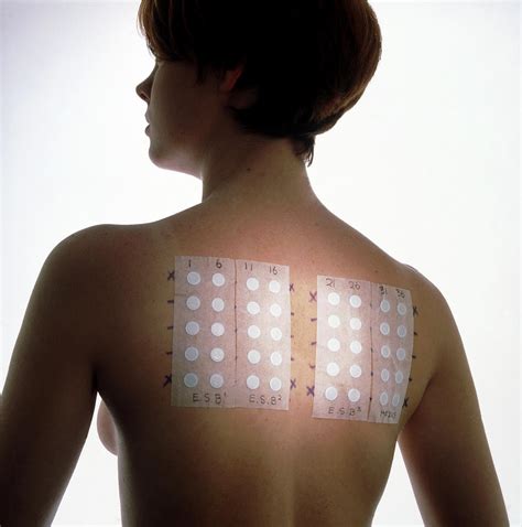Young Woman With Allergy Test Patches On Her Back Photograph By Saturn