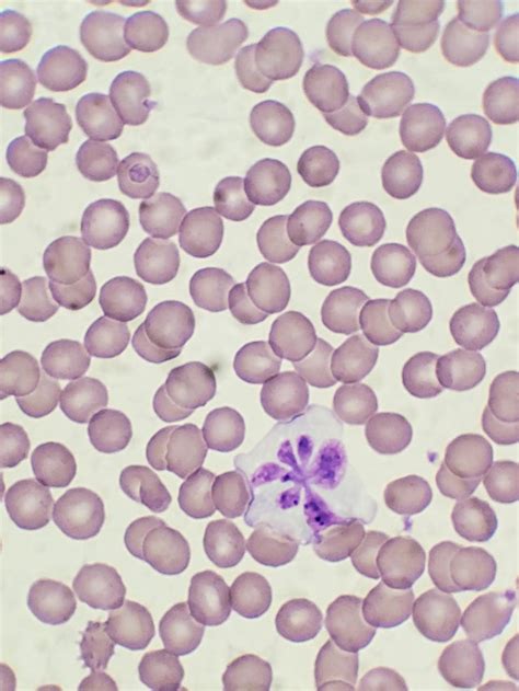 Saw These On A Smear Today Interesting Atypical Lymphs Never Seen The